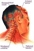 obat herbal penyakit migrain